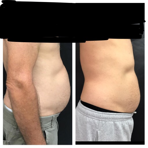 Cellulite and Fat Reduction & Body Contouring Revivify Medical Spa