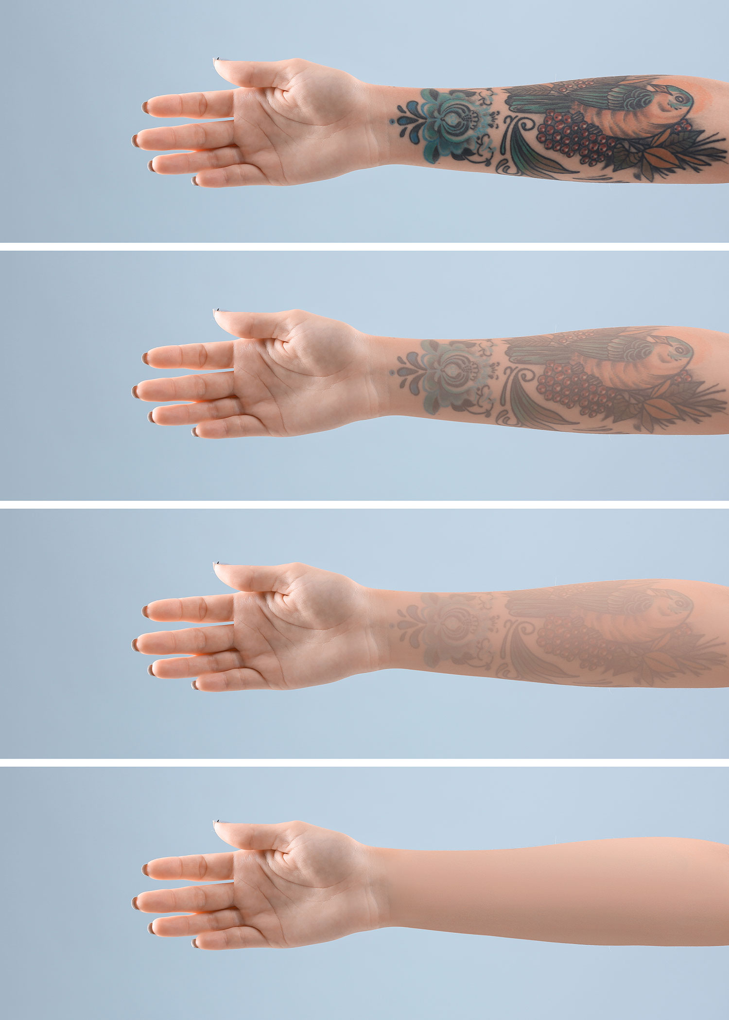 Laser Tattoo removal