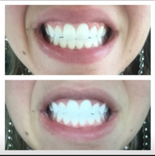 Laser Teeth Whitening Revivify Medical Spa Contact Us today