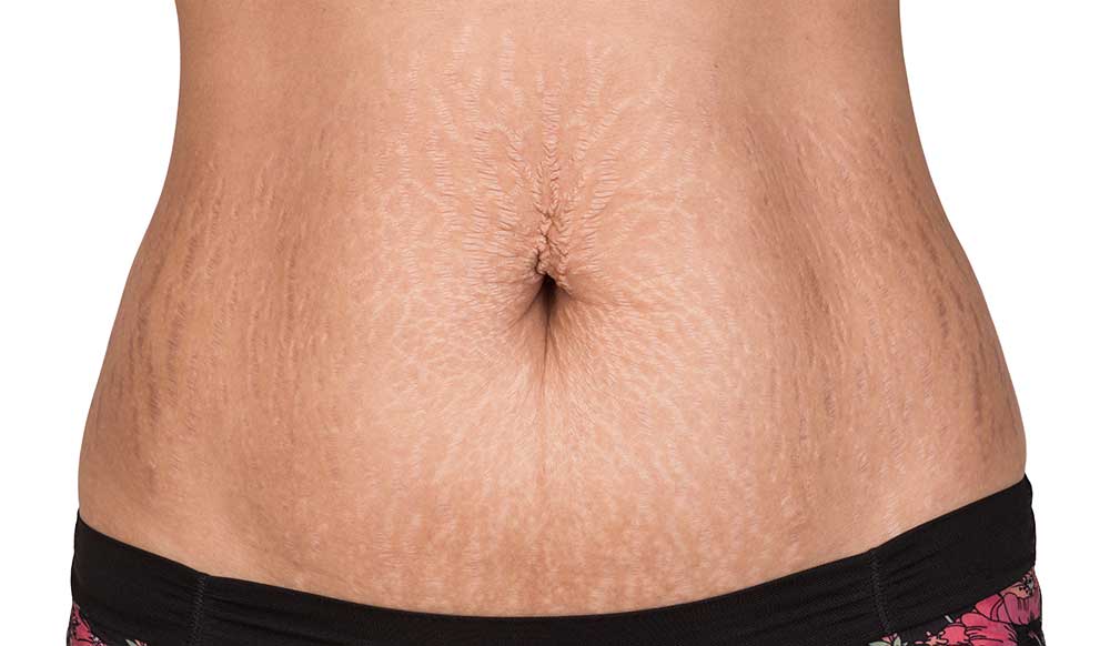 Stretch Marks Treatment