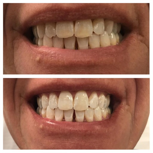Laser Teeth Whitening Revivify Medical Spa Contact Us today